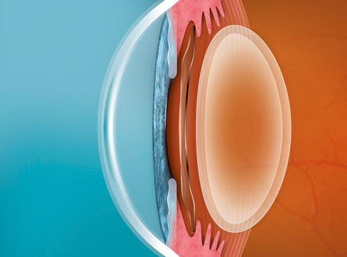 Recovery Time After Vision Correction Surgery: Compare Your Options