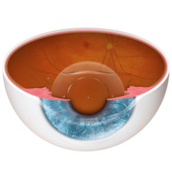 Contact Lens Intolerance and How to Relieve It