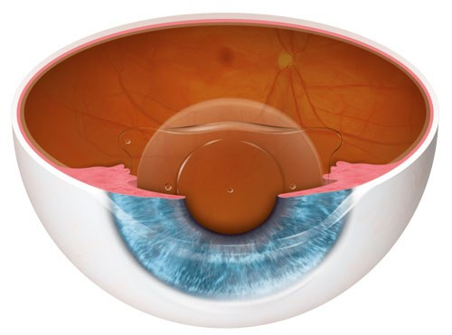 Dry Eyes After Refractive Surgery